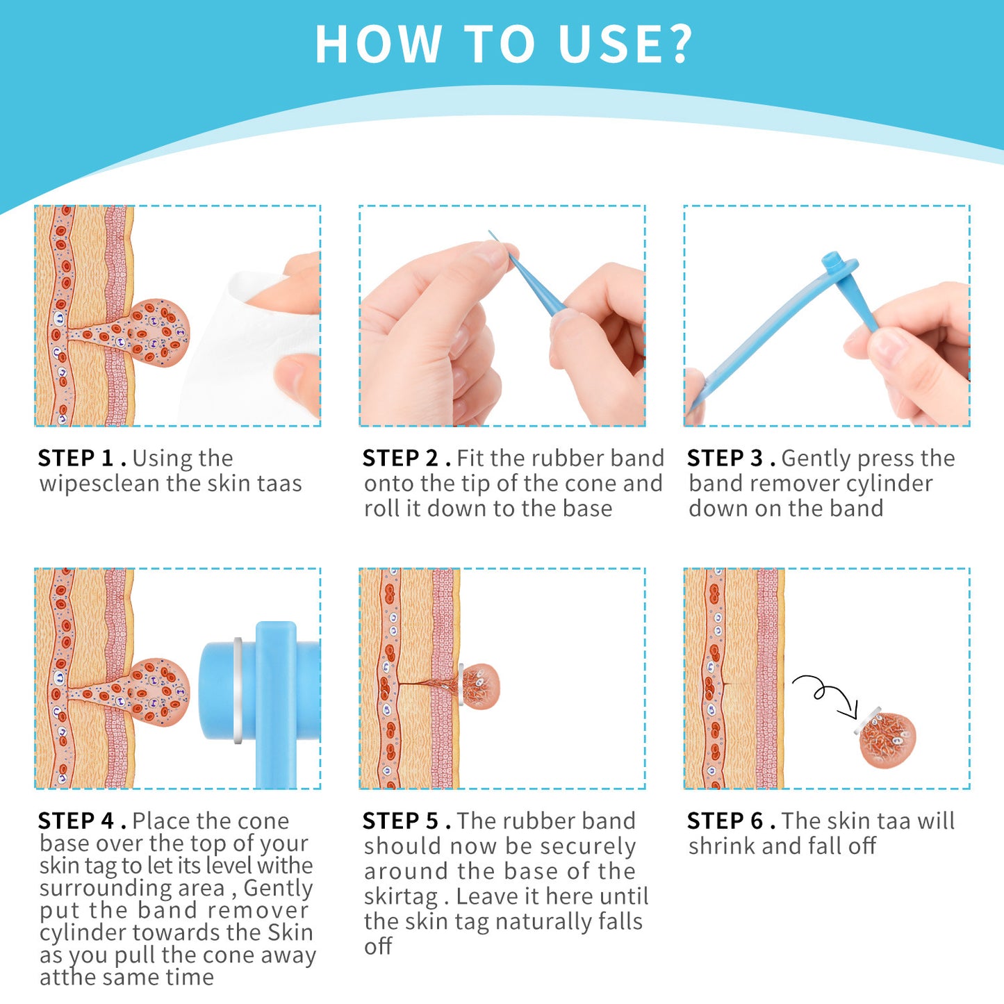 Skin Tag Remover